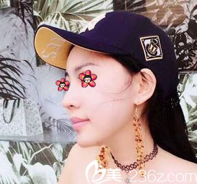 本來去找張小紅院長(zhǎng)做鼻子,結(jié)果院長(zhǎng)參加會(huì)議了,讓別的醫(yī)生幫我做的,沒想到結(jié)果挺成功的