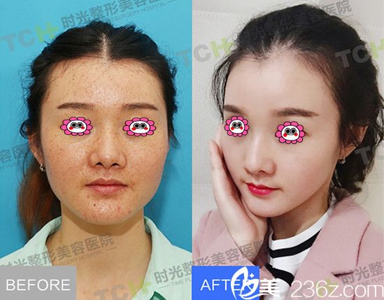 我在重慶時光整形醫(yī)院祛斑前后效果圖