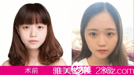 衡陽(yáng)雅美翹睫美瞳真人案例