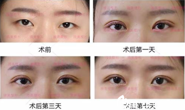 衡陽(yáng)雅美雙眼皮手術(shù)術(shù)后恢復(fù)一周的過(guò)程