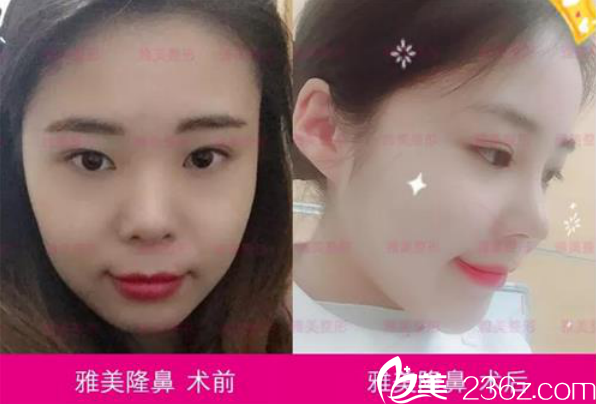 衡陽(yáng)雅美無(wú)痕小翹鼻真人案例