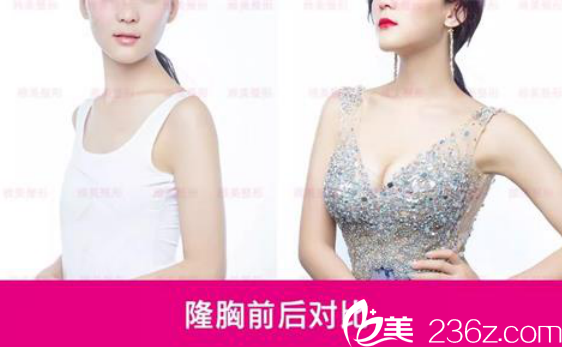 衡陽(yáng)雅美隆胸真人案例