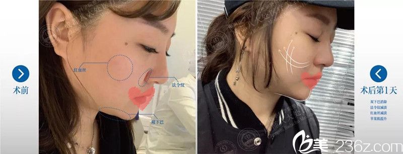 成都<!--<i data=20240709-sp></i>-->整形王萍線雕案例 成都<!--<i data=20240709-sp></i>-->整形王萍線雕案例