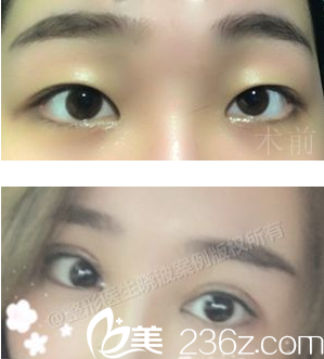 成都<!--<i data=20240709-sp></i>-->于曉波雙眼皮術(shù)后照片