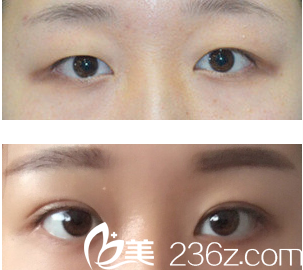 于曉波微創(chuàng)三點(diǎn)雙眼+開眼角