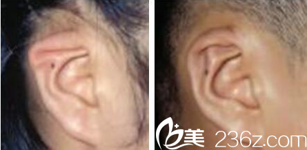 <!--<i data=20240709-sp></i>-->于曉波耳畸形修復(fù)術(shù)后效果