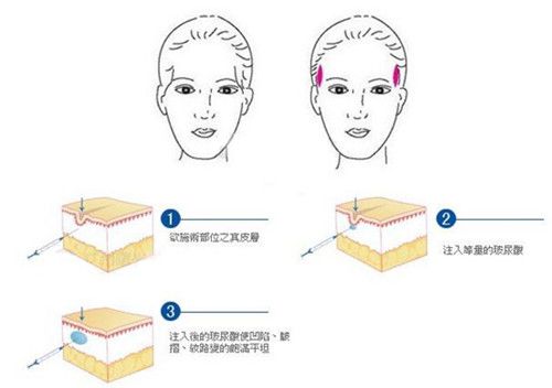 玻尿酸注射豐太陽(yáng)穴原理