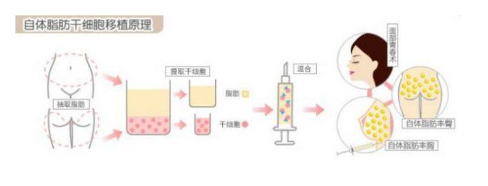 自體脂肪填充太陽(yáng)穴過(guò)程