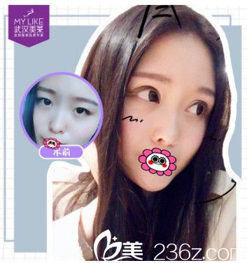 武漢美萊卓田雙眼皮前后對比照