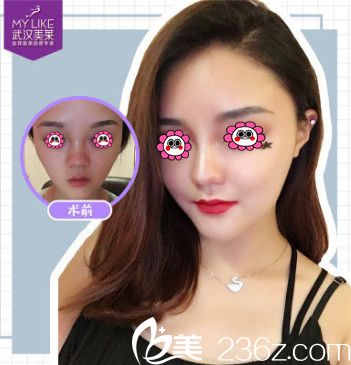 我在武漢美萊找余萌做達(dá)拉斯綜合隆鼻效果圖