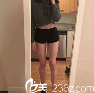 在北京畫美醫(yī)院做腿部吸脂第31天<span style= 在北京畫美醫(yī)院做腿部吸脂第31天<span style=