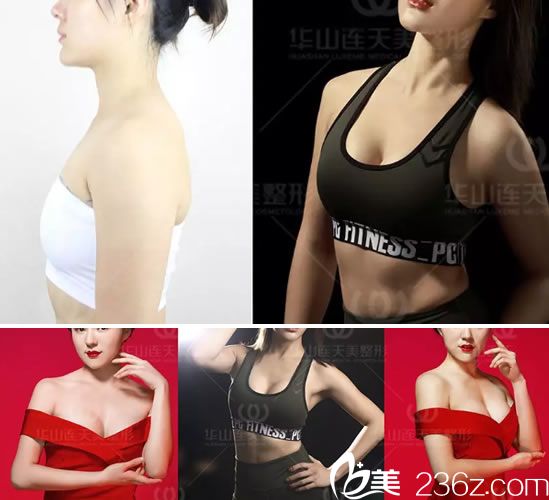 連天美程琳假體隆胸案例