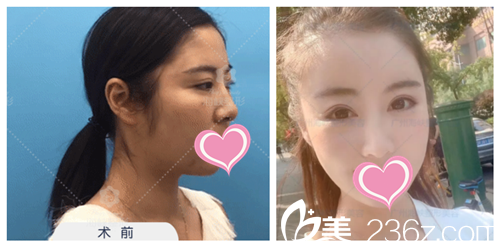 李希軍隆鼻案例效果對(duì)比圖 李希軍隆鼻案例效果對(duì)比圖