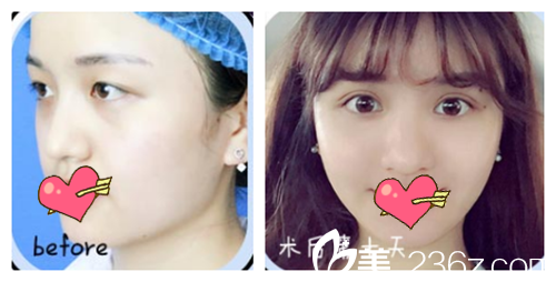 廣州海峽郭棟雙眼皮案例術(shù)前術(shù)后十天效果 廣州海峽郭棟雙眼皮案例術(shù)前術(shù)后十天效果