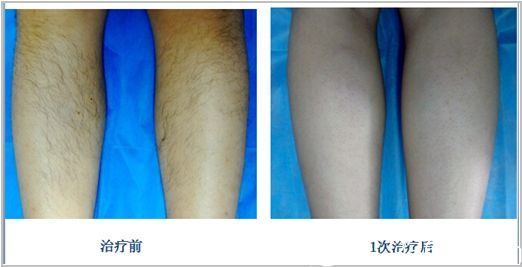 泰州碧昂卡韓術(shù)引進(jìn)韓國(guó)月光脫毛技術(shù)優(yōu)惠價(jià)格單次體驗(yàn)只要11元