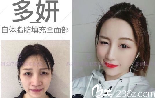 有隆鼻打算的寶寶，建議做之前先看2019跨年蚌埠多妍整形價格表及真人案例