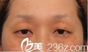 切開法雙眼皮和眼瞼下垂修正手術(shù)前 切開法雙眼皮和眼瞼下垂修正手術(shù)前