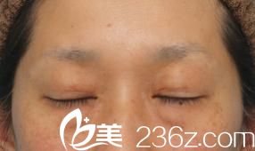 切開法雙眼皮和眼瞼下垂修正手術(shù)后閉眼時(shí)候的樣子 切開法雙眼皮和眼瞼下垂修正手術(shù)后閉眼時(shí)候的樣子