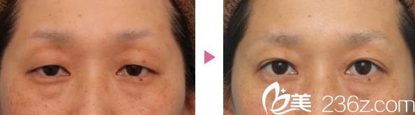 切開法雙眼皮和眼瞼下垂修正手術(shù)前后對(duì)比 切開法雙眼皮和眼瞼下垂修正手術(shù)前后對(duì)比