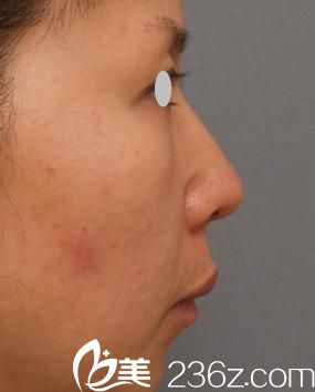 鼻尖軟骨移植前 鼻尖軟骨移植前