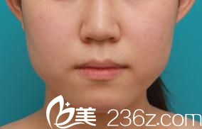 臉型整形前 臉型整形前