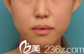 日本哪家臉型整形醫(yī)院好?我在日本高須美容整形醫(yī)院高須克彌那里做的面部輪廓整形，從此有了巴掌小臉