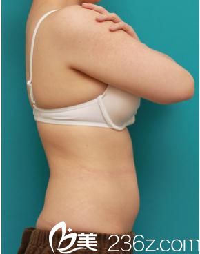 吸脂手術(shù)前 吸脂手術(shù)前