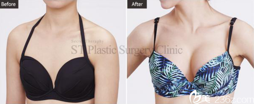 韓國(guó)ST整形外科案例 韓國(guó)ST整形外科案例