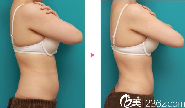 吸脂手術(shù)前后對比 吸脂手術(shù)前后對比
