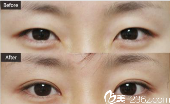 韓國(guó)ST整形外科醫(yī)院案例 韓國(guó)ST整形外科醫(yī)院案例