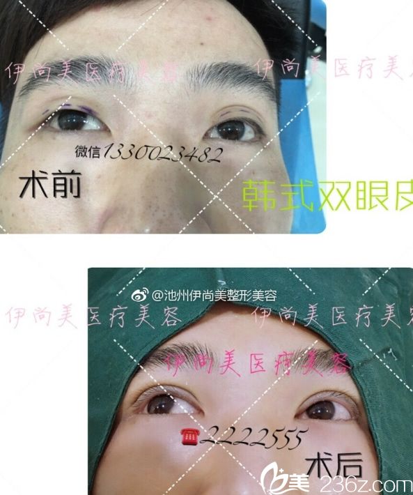 跨年大促池州伊尚美整形優(yōu)惠價(jià)格表公布 除皺針/瘦臉年卡僅需2980元