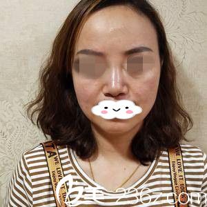 假體隆鼻失敗的我 假體隆鼻失敗的我