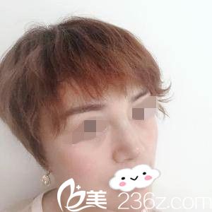 鼻修復(fù)一周后的效果 鼻修復(fù)一周后的效果