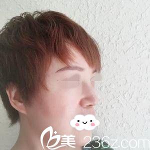 鼻修復(fù)半個月的效果 鼻修復(fù)半個月的效果