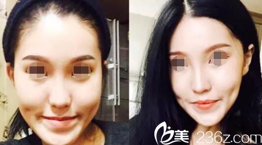 韓國原辰下顎前凸術(shù)前 韓國原辰下顎前凸術(shù)前