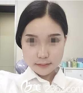 術(shù)后7天腫脹明顯 術(shù)后7天腫脹明顯