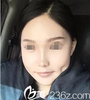 下顎前凸術(shù)后14天逐漸恢復(fù)中 下顎前凸術(shù)后14天逐漸恢復(fù)中