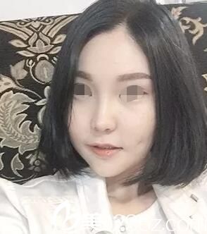 術(shù)后3個(gè)月余腫漸漸消失 術(shù)后3個(gè)月余腫漸漸消失