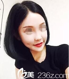 金光鎮(zhèn)院長下顎前凸術(shù)后6個(gè)月 金光鎮(zhèn)院長下顎前凸術(shù)后6個(gè)月