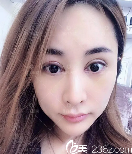 找易培金做完雙眼皮術(shù)后3天照片