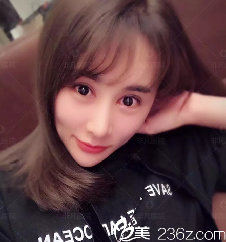 這是找易培金做的雙眼皮術(shù)后15天恢復(fù)情況