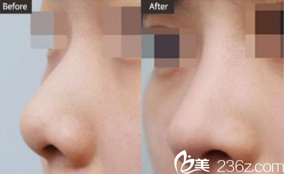 韓國(guó)ST整形醫(yī)院短鼻/鷹鉤鼻對(duì)比圖 韓國(guó)ST整形醫(yī)院短鼻/鷹鉤鼻對(duì)比圖
