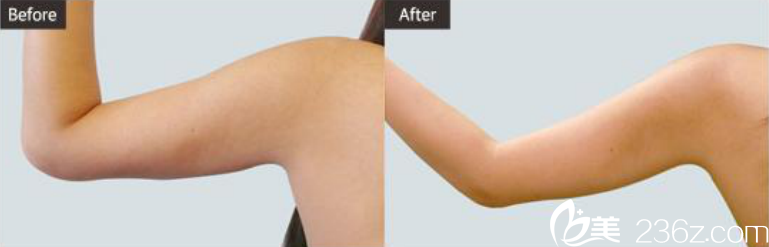 韓國(guó)ST整形醫(yī)院吸脂術(shù)對(duì)比圖 韓國(guó)ST整形醫(yī)院吸脂術(shù)對(duì)比圖