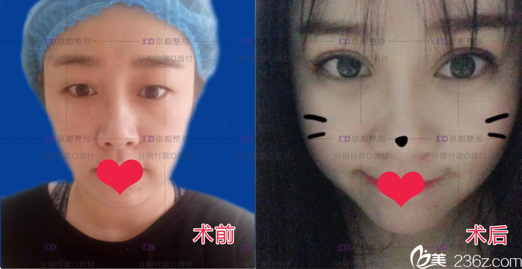 保定京都雙眼皮效果圖