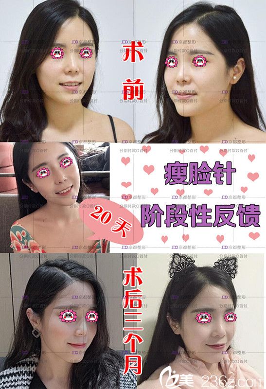 我在保定京都打完瘦臉1-3個月變化圖