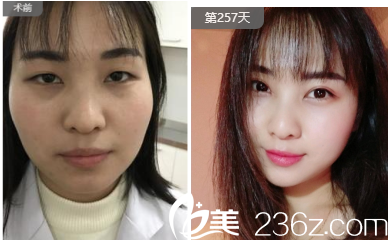 切開雙眼皮案例