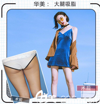 華美孫奇醫(yī)生做吸脂手術(shù)案例