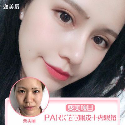 深圳非凡黃純做的雙眼皮開眼角案例 深圳非凡黃純做的雙眼皮開眼角案例