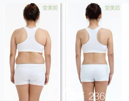 深圳非凡黃純做的腰腹部吸脂案例 深圳非凡黃純做的腰腹部吸脂案例