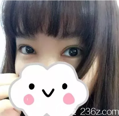 在玉林華美做雙眼皮手術(shù)20天后改善了我的腫眼泡單眼皮